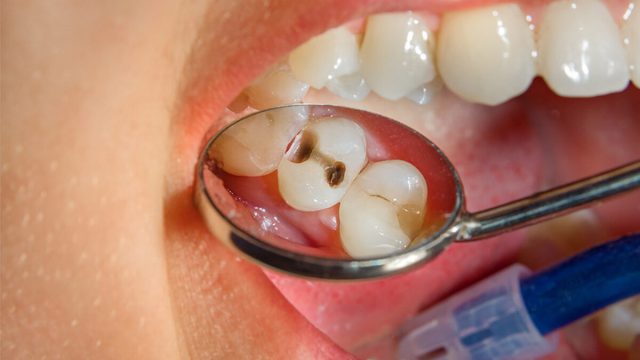 تفسير تسوس الاسنان في المنام لمختلف الحالات