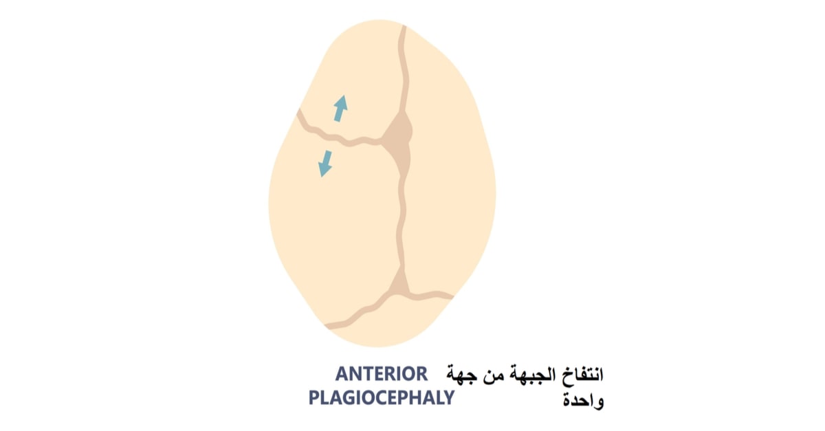انتفاخ جبهة الطفل من جهة واحدة من الجمجمة